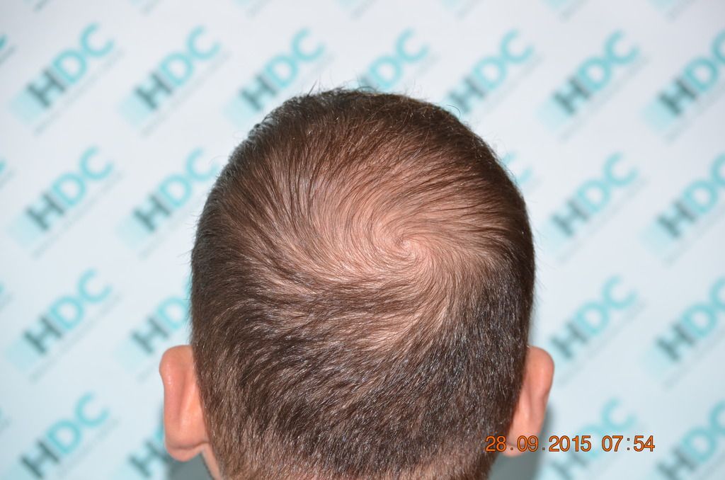 Hdc Hair Transplant Clinic Fue Result Of Grafts Post Op Of Rd